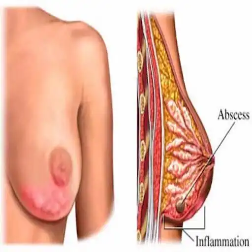 Play Breast mastitis and treatment APK