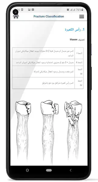 Play Fracture Classification Arabic as an online game Fracture Classification Arabic with UptoPlay