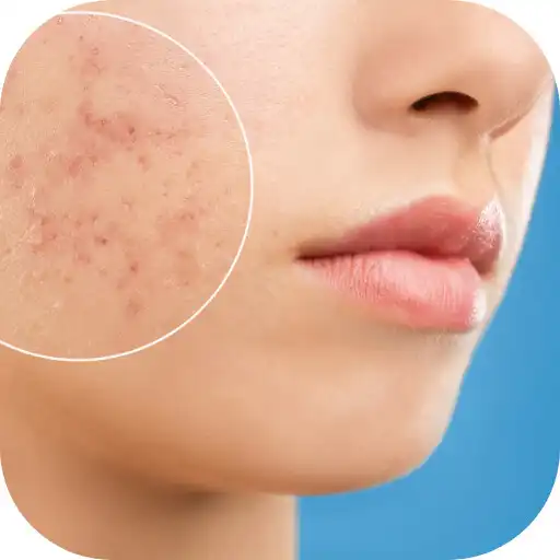 Play fungal acne treatment APK