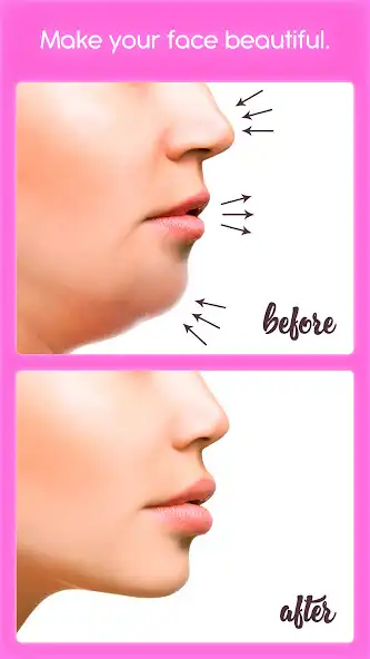 Play Rhinoplasty