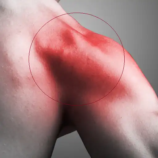 Play Rotator Cuff Tear Exercises APK