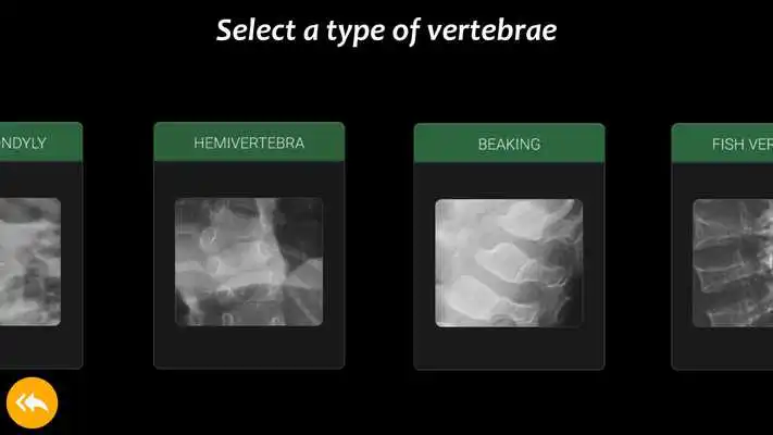 Play Skeletal Dysplasia View: Spine